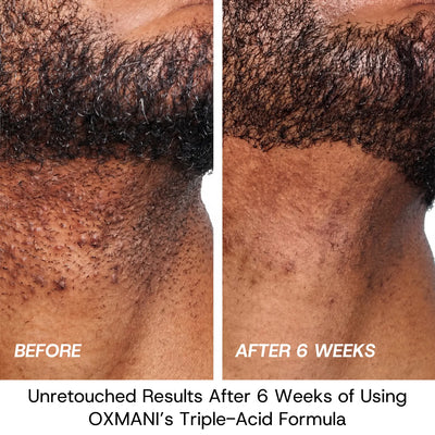 Post-Shave Ingrown Hair Serum