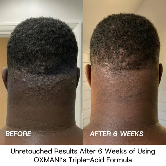 Post-Shave Ingrown Hair Serum